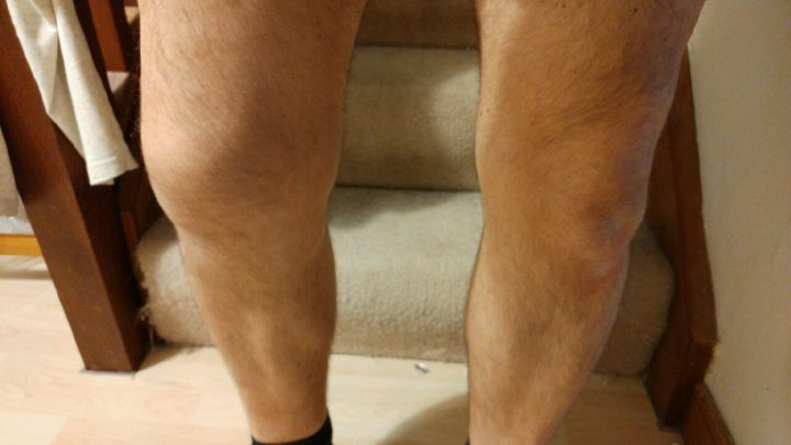 Leg injury - A&E? - Page 1 - Health Matters - PistonHeads