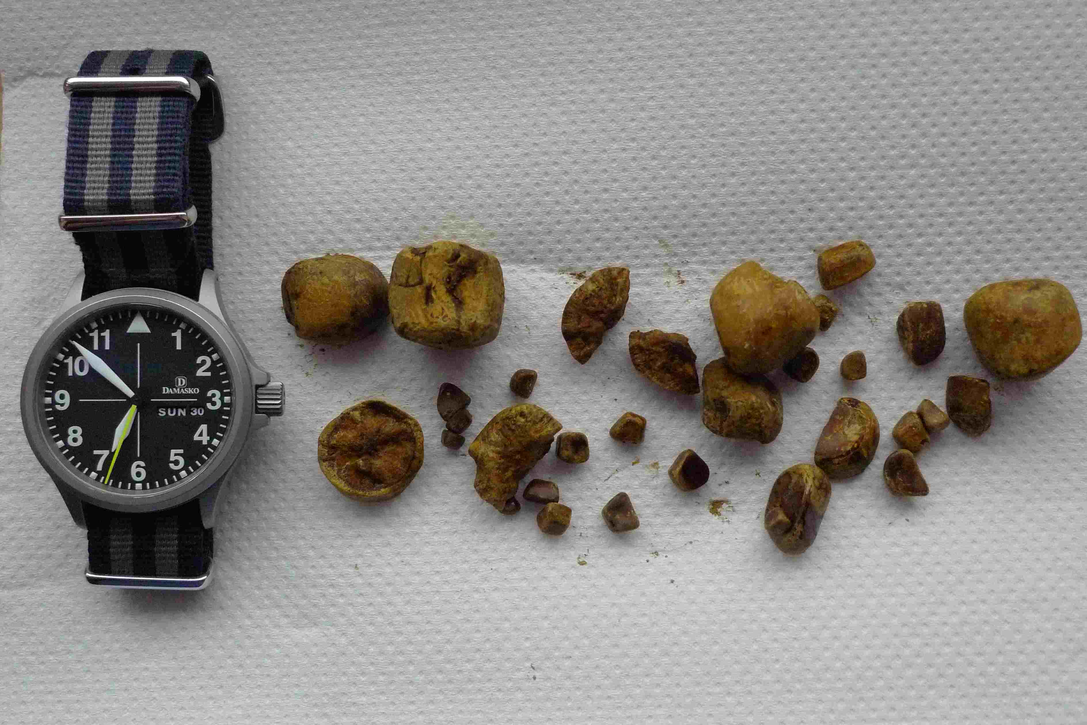 Having my gallbladder removed, what to expect re’ recovery - Page 4 - Health Matters - PistonHeads UK - The image displays a black watch with a white face and a single blue second hand on a surface. Adjacent to the watch, there is a pile of crushed poppy seeds, which appear to be from an opium poppy plant. The seeds are clustered together and look freshly collected. In the background, there is no clear context or additional details, but it seems to be a plain white surface that could be a table or desk. There are no texts or other objects present in the image. The focus is solely on the watch and the opium poppy seeds.