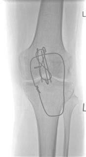 Parking Beeper Volume - Page 1 - Aston Martin - PistonHeads - The image is a medical X-ray focused on a human knee joint. The image is in black and white, providing a detailed view of the bone structure without the contrast of soft tissue. The most striking feature is a magnetic resonance imaging (MRI) labeled "MR" on the knee, which colorfully stands out against the grayscale background. This indicates that the knee has undergone an MRI scan, which is a diagnostic medical imaging technique used to visualize the internal structure and tissue of the knee. The presence of the MRI suggests that the image might be used for diagnostic or educational purposes, showcasing the guidelines or results of the scan. The MRI uses contrasted colors to visualize the various tissue types within the knee, aiding in diagnostic and treatment planning.