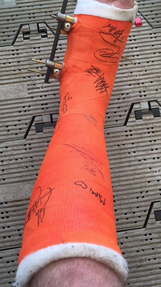 A picture a day....biker banter (Vol 4) - Page 261 - Biker Banter - PistonHeads - The image shows a human leg encased in a below-the-knee cast. The cast is orange and contains a mix of scribbles and writings in various styles and sizes. These markings seem to be autographs, and each one is likely the signature of a different person. The cast is secured by two metal bars that are likely crossbars or a splint system. The person whose leg is in the cast appears to be male, and only a small part of his lower leg, from the knee to the ankle, is visible in the image. The background is nondescript and does not provide any context or additional information about the setting or situation.