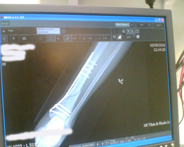 Pistonheads Ankle Broken Tib Fractured Fib