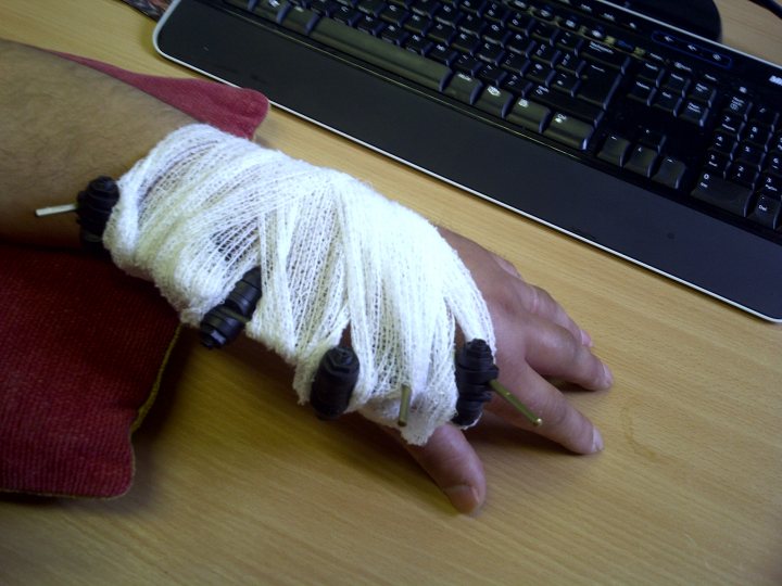 Pistonheads - The image showcases a person's arm prominently filling the frame. The individual appears to be typing on a computer keyboard which is partially visible on the right side of the image. Attached to the wrist is a black and white band, and thus, it is not possible to see the full arm. The rest of the arm is wrapped in a white bandage, indicating possible injury or treatment.