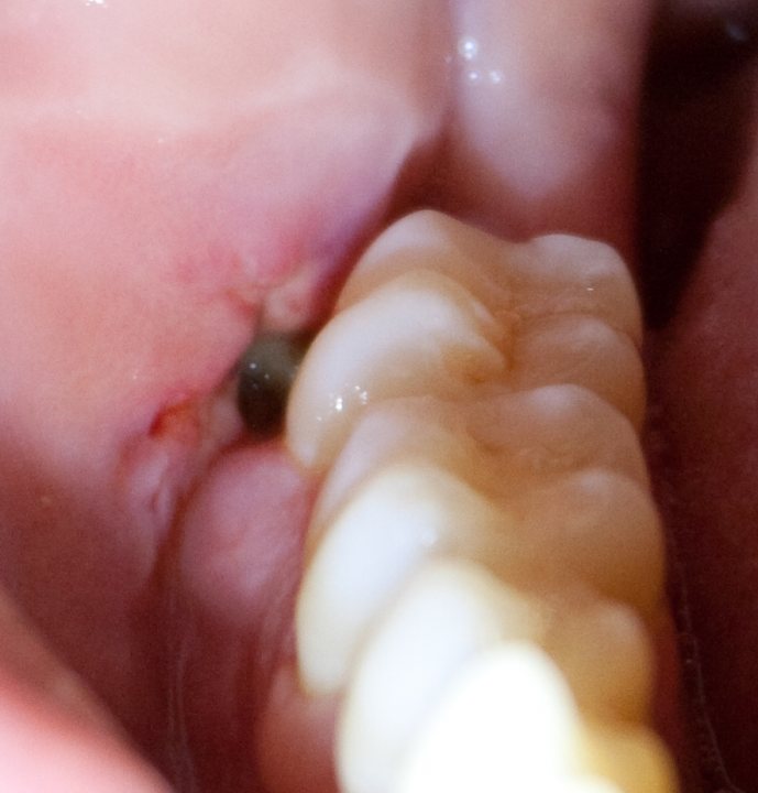 Extractedlower Teeth Wisdom Pistonheads Jaw Infected
