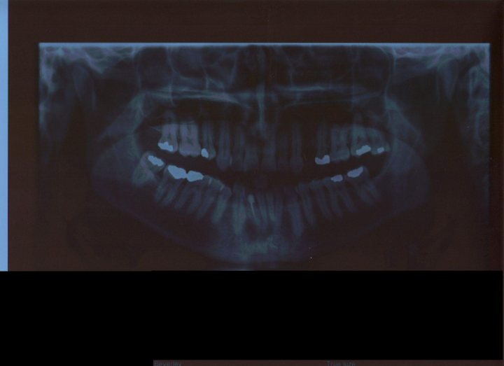 Jaw Joints Tmj Pistonheads - The image is a side view X-ray of a mouth. It shows a set of teeth, with many of them appearing sharp and white against the darker background of the X-ray. The bone structure of the jaw is also visible, with individual teeth embedded in the supporting bone. The darkest area seems to be the nasal cavity. The positioning suggests that this image is likely used for dental examination purposes, possibly as part of a dental check-up or diagnosis procedure.