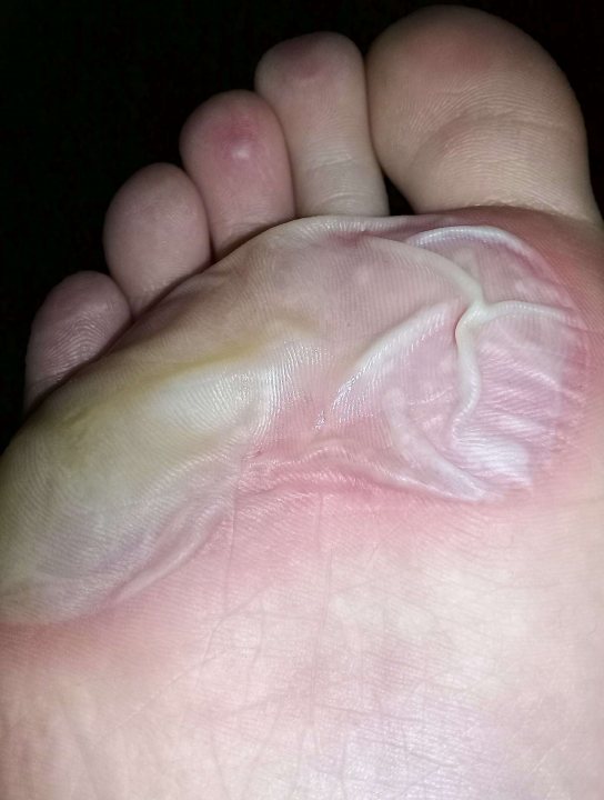 A person laying on a bed with a blanket - Blister