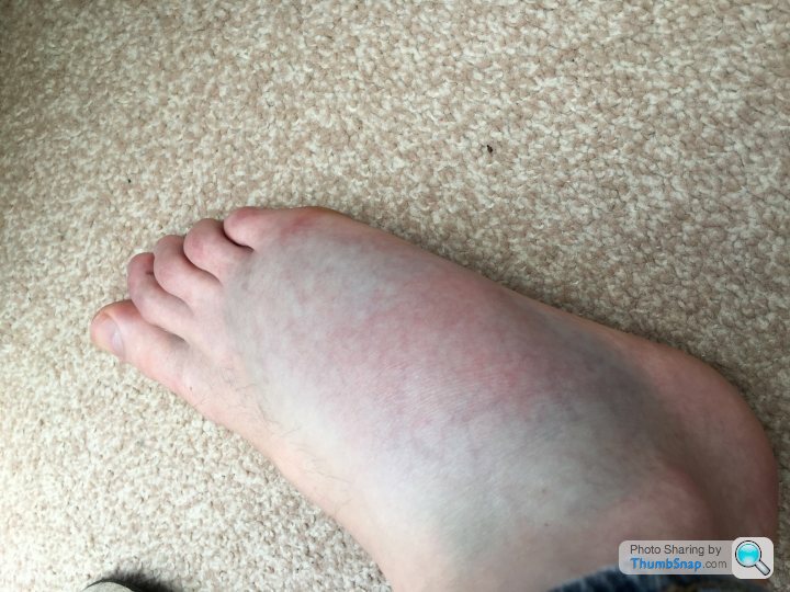 my heel feels like it's bruised