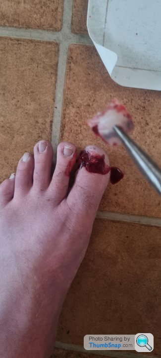 Nails ripped away from nail bed.. bleeding and painful please help! | Salon  Geek - Salon Professionals Forum