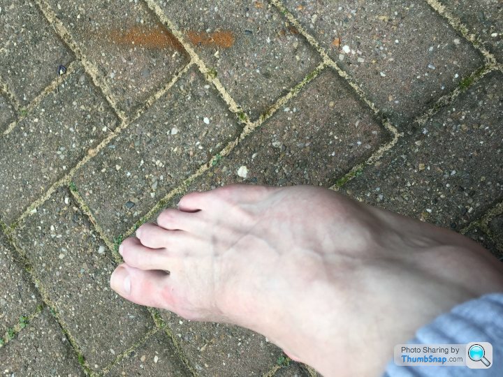 Broken Or Just Bruised Foot Page 1 Health Matters Pistonheads Uk