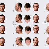 Baldness - Page 4 - Health Matters - PistonHeads